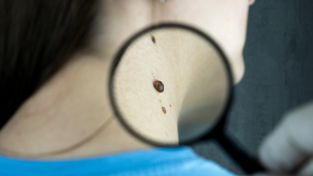 Piel, El cáncer de piel se puede prevenir: Aprende a identificar el melanoma