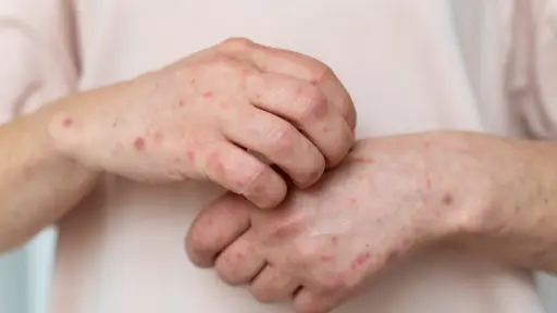 Dermatitos atópica ,freepik.es