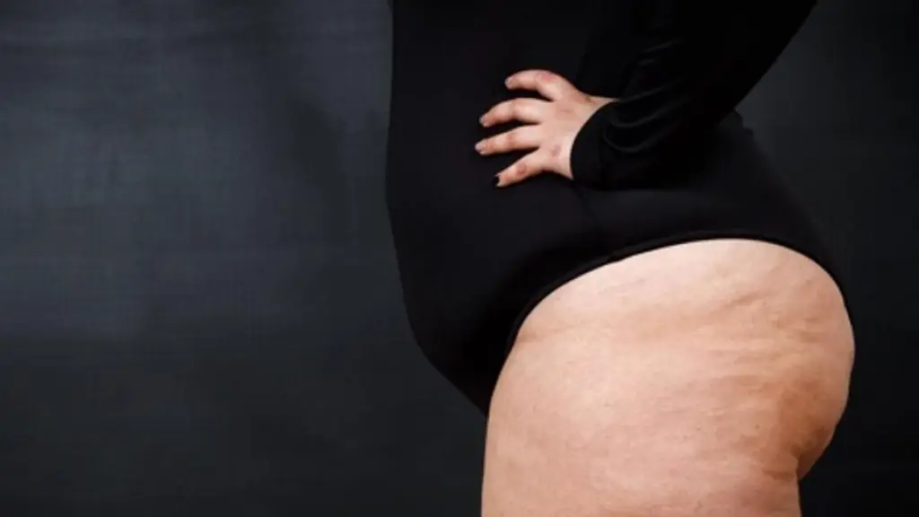 Lipedema, eldiario.es