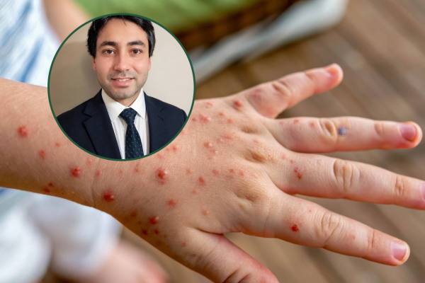 Brote de varicela en Hualpén activa alerta con 29 casos y riesgo de contagio en colegios