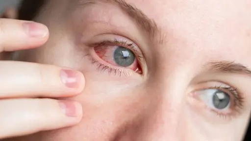 Alergia irritación en los ojos ,Prensa