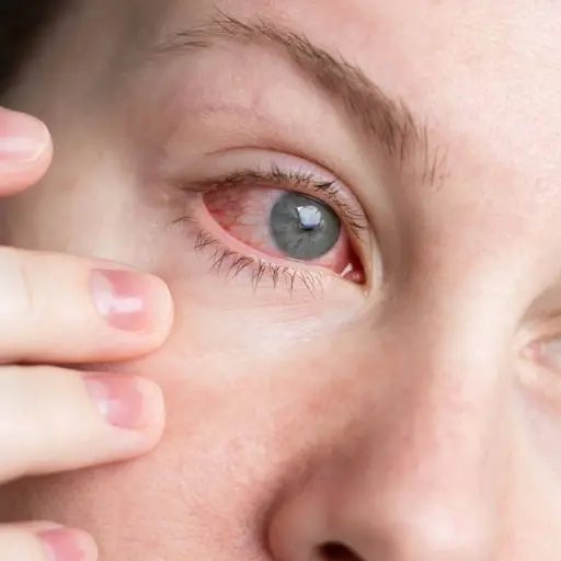 Alergia irritación en los ojos ,Prensa